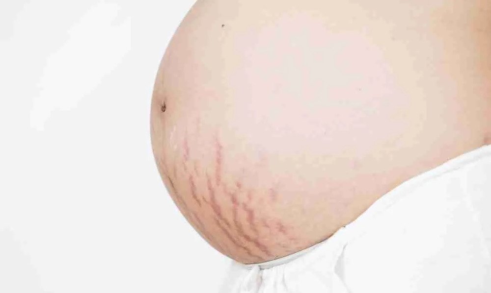 Estrias na Gravidez: As 9 Melhores Maneiras de Evitar e Tratar com Segurança