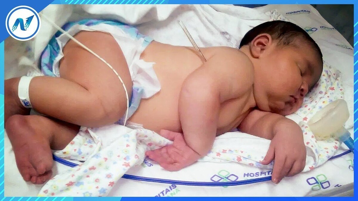 Macrossomia Fetal: O Que É, Causas, Riscos e Tratamento