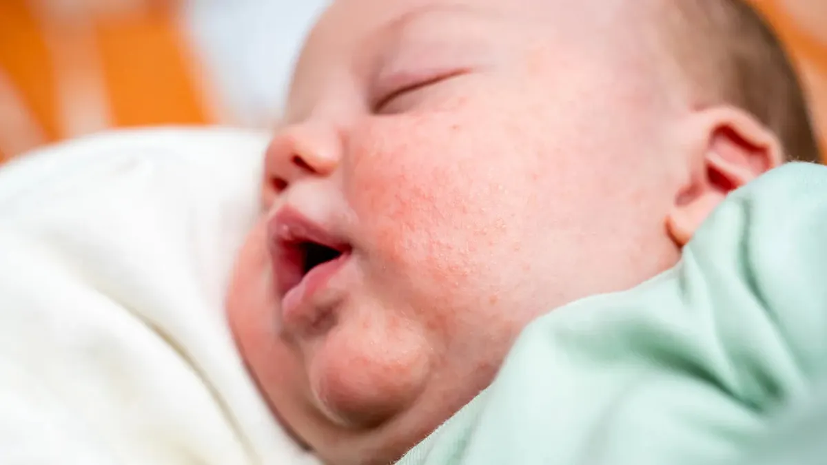 Brotoeja em Bebê: Por que Aparece Brotoeja em Bebês