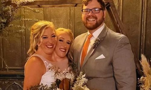Gêmeas Siamesas Abby e Brittany Surpreendem ao Falar Sobre Gravidez Após Casamento Revelado