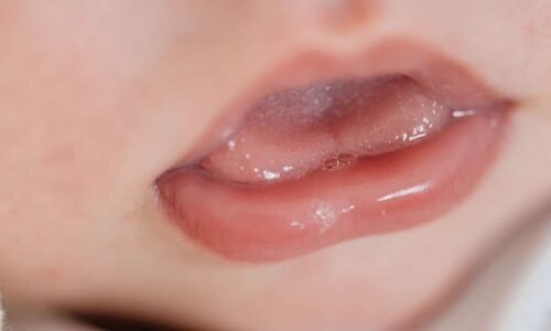 Frenectomia em Bebês: Quando a Cirurgia para Língua Presa é Necessária