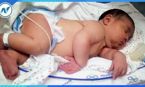 Macrossomia Fetal: O Que É, Causas, Riscos e Tratamento